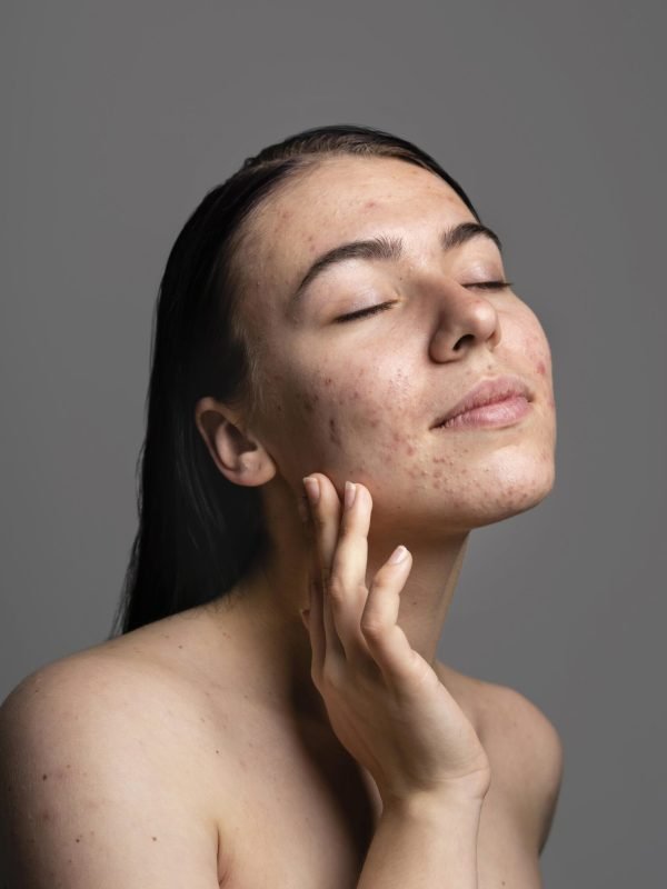 portrait-young-woman-being-confident-with-acne portrait-young-woman-being-confident-with-acne